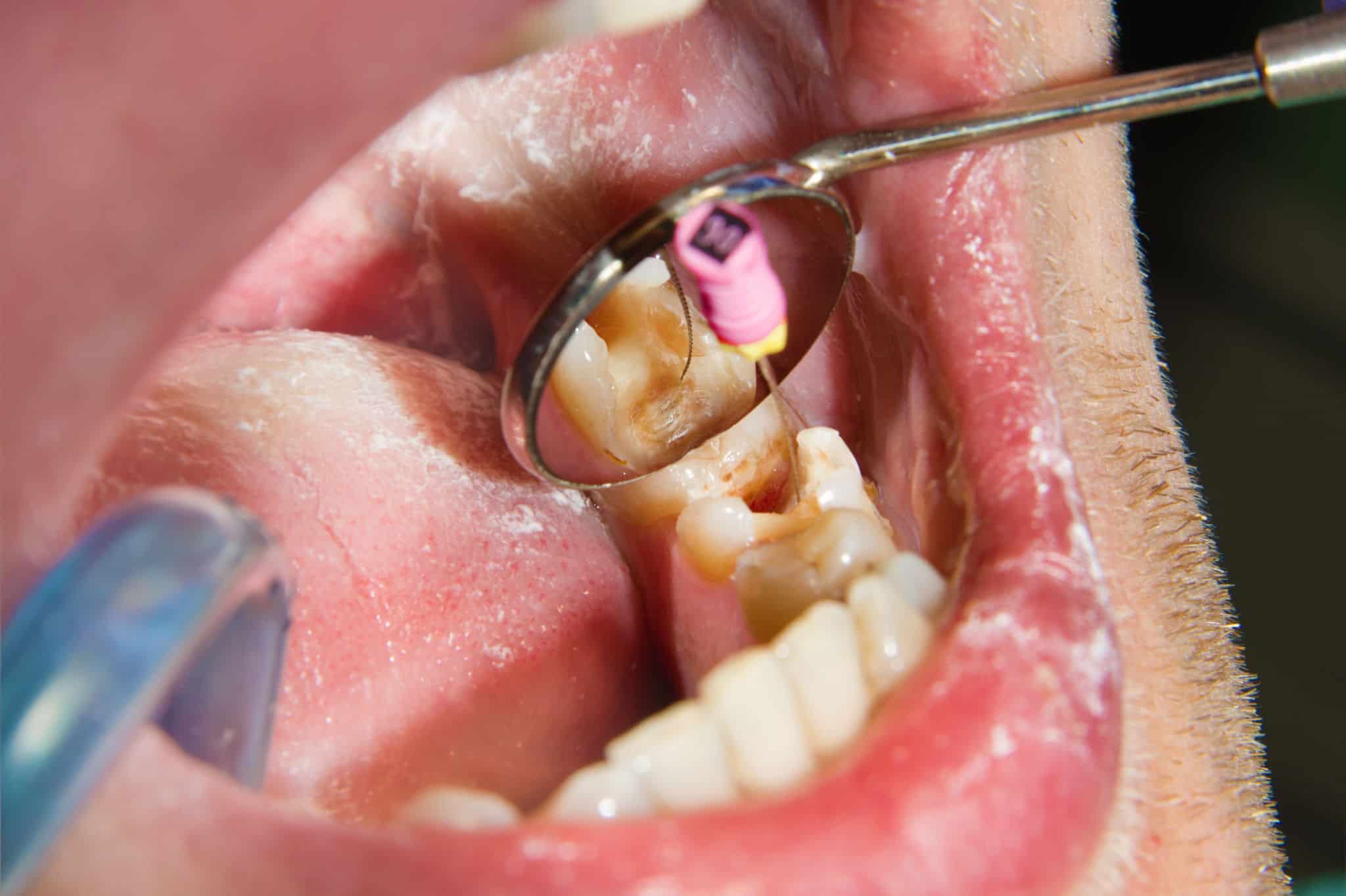 Does a Root Canal have Side Effects?