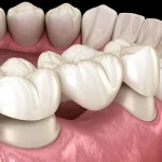 5 Things to Consider for Dental Crowns and Bridges for Tooth Restoration in NYC