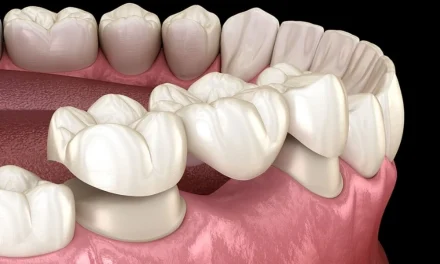 5 Things to Consider for Dental Crowns and Bridges for Tooth Restoration in NYC